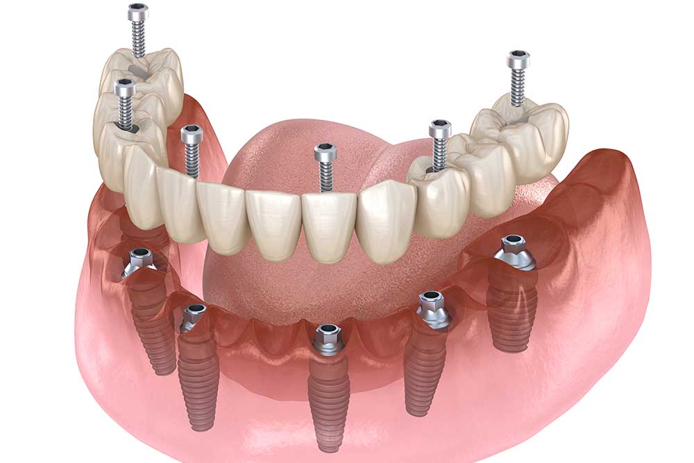Protesi - Dental Med Travel - Dental Prosthetics
