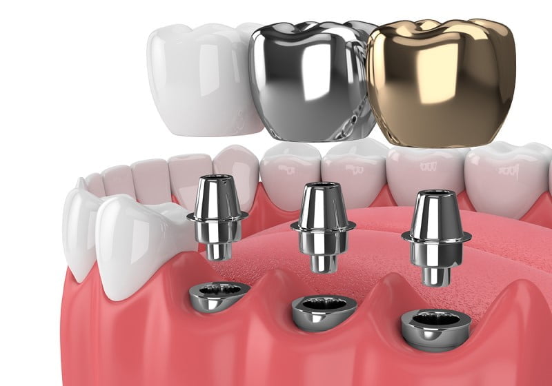 dental implants?