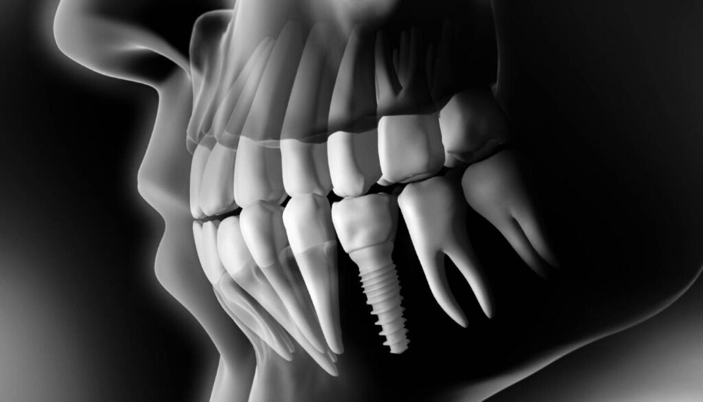 dental implants