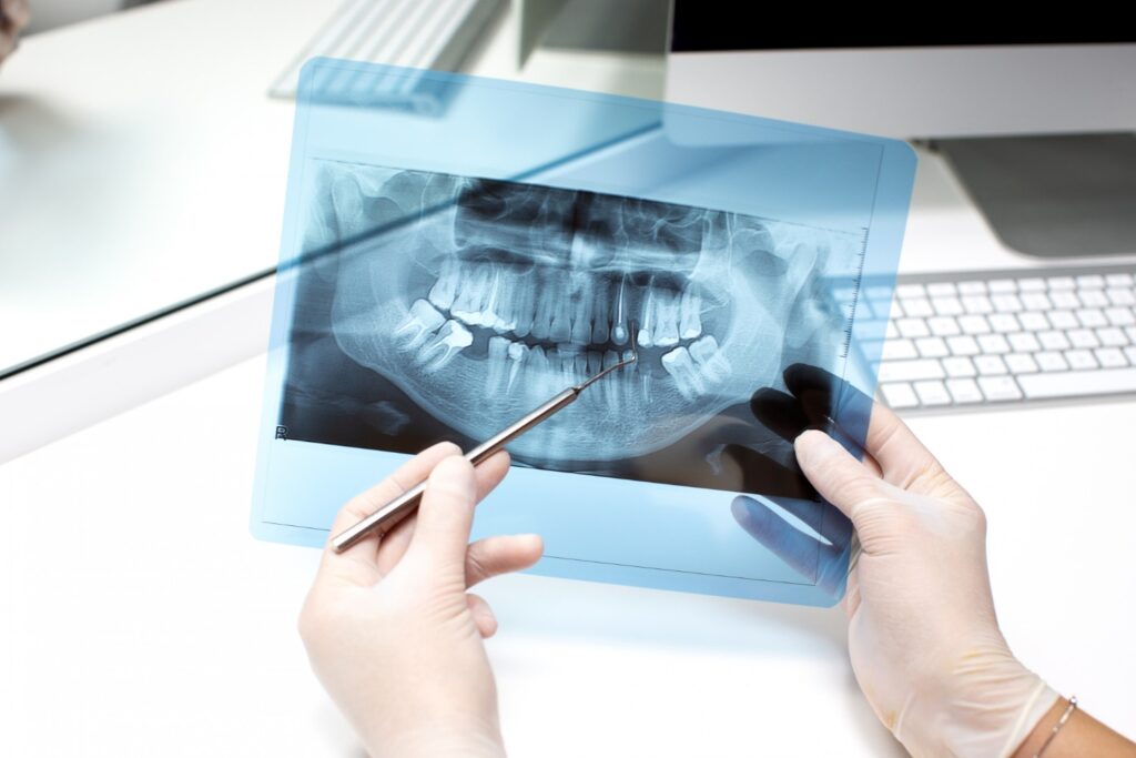 dental implants guide
